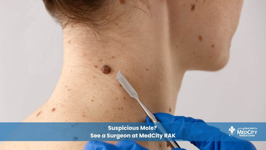 Suspicious Mole? See a Surgeon at MedCity RAK